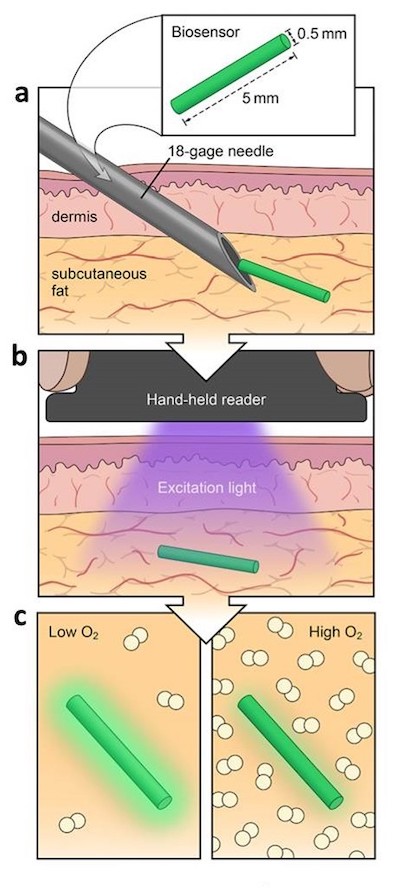 Illustration of biosensor under the skin