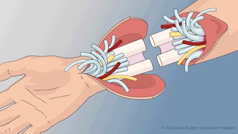 Hand transplant illustration