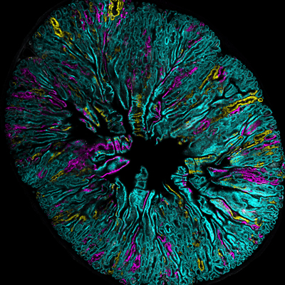 Left: Cancer rainbow modeling of intratumor heterogeneity in colorectal cancer. Image courtesy of Dr. Joshua Snyder 