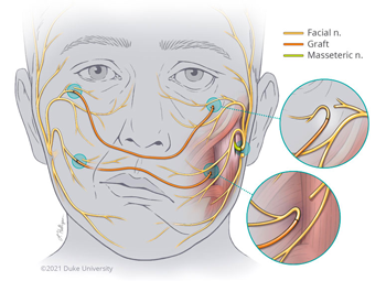 Illustration of facial reanimation surgery