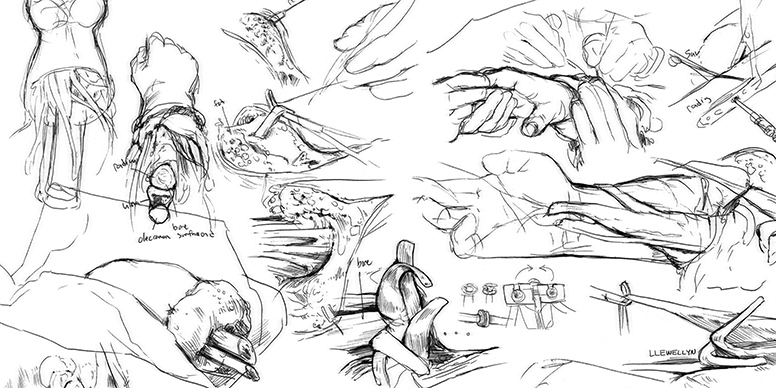 Sketches of the hand transplant procedure by Duke medical illustrator Megan Llewellyn, MSMI, CMI.