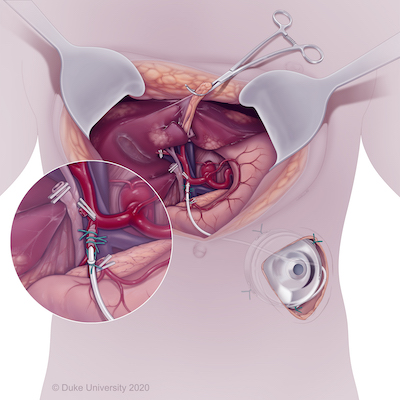 Illustration of hepatic artery infusion