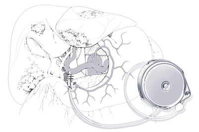 Hepatic artery infusion provides a direct path to cancerous tissue through a subcutaneously placed pump and arterial catheter. Illustration by Megan Llewellyn.