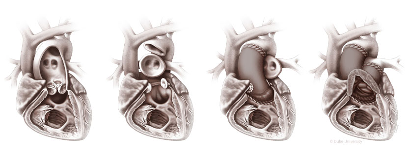 A four-panel realistic illustration of the steps of a partial heart transplantation