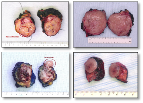 Images of phyllodes tumors being examined in a study
