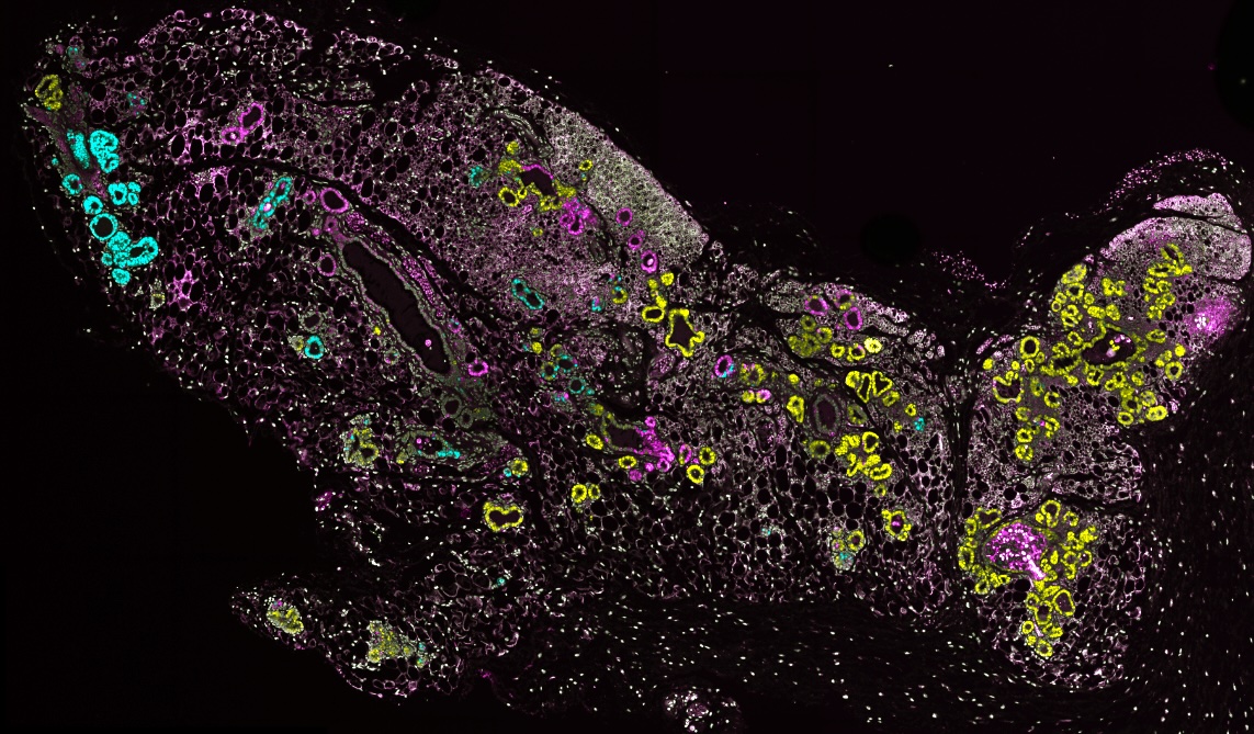 Clonal tracing of fluorescent oncogenes