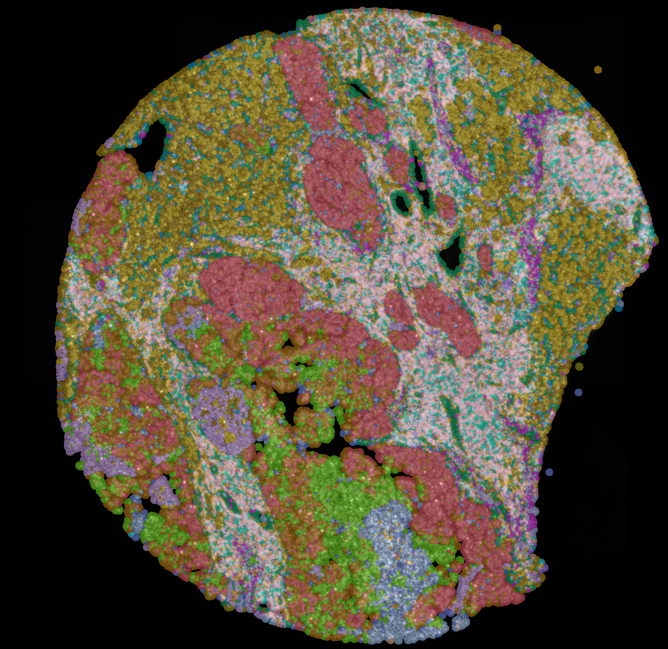 Spatial transcriptomics of breast cancer