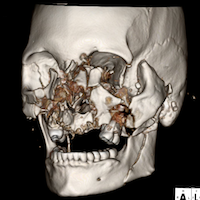 3D CT scan showing complex craniomaxillofacial fractures and dislocations.