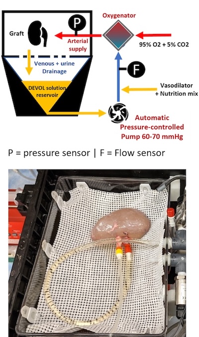 Ex vivo kidney perfusion in the DEVOL