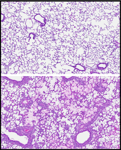 Figure Y: Acute cellular rejection is characterized by significant tissue infiltration of recipient T lymphocytes. Images from non-rejecting (top) and rejecting rat lung (bottom) demonstrate this phenomenon.