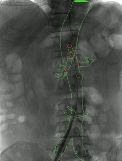 X-ray image of spine, with CT overlay