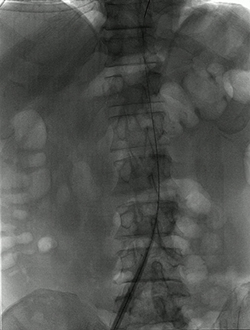 X-ray image of spine