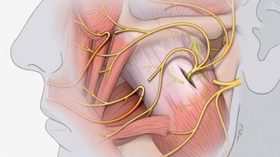 Illustration of facial reanimation surgery