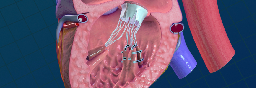 Illustration of pediatric heart valves