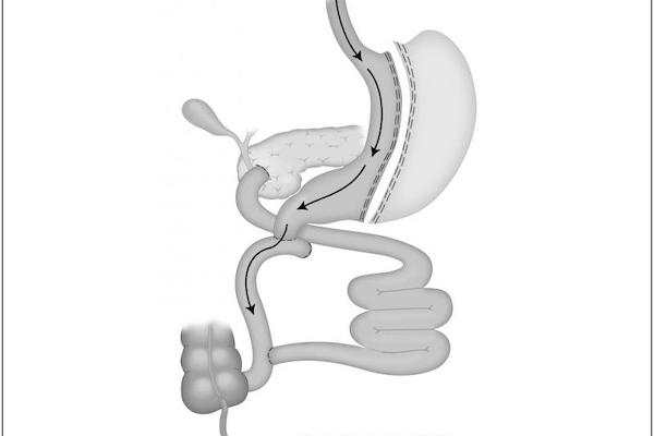 Duodenal Switch