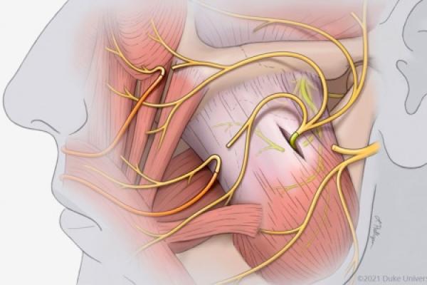 Illustration of facial reanimation surgery