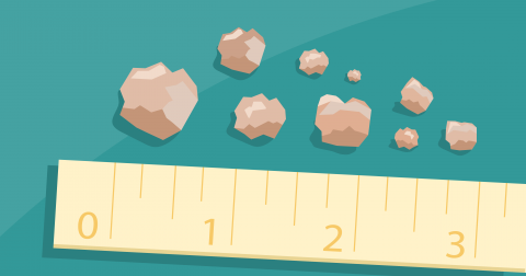 Illustration of kidney stone sizes