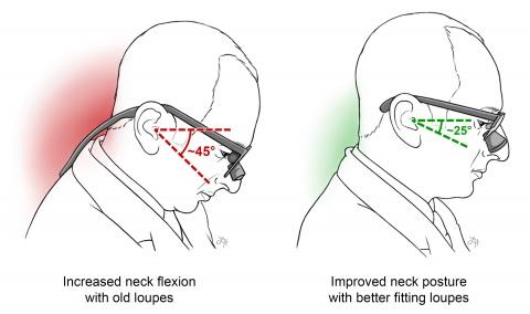 Illustration of ergonomic loupes positioned correctly