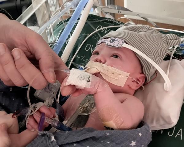 Partial Heart Transplant Patient Baby Owen