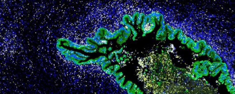 Pancreatic cancer tissue