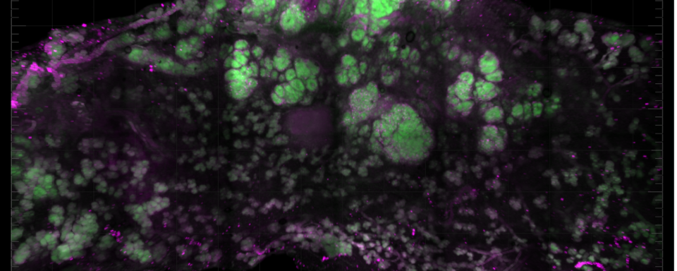 fluorescence microscopy view of a tissue sample with bright green and magenta areas indicating the presence of specific cellular structures or markers within the tumor-immune microenvironment