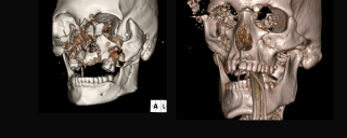 3D CT facial bone scans showing complex maxillofacial fractures and injuries.