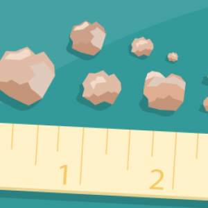 Illustration of kidney stone sizes