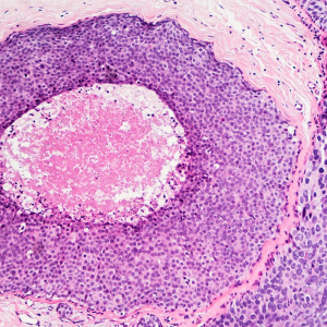 Ductal carcinoma in situ, the appearance of tumor cells within the mammary ducts (shown here in a microscope image), is the earliest form of breast cancer and affects 55,000 people per year in the United States.
